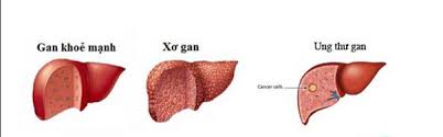 gan nhiễm mỡ có thể dẫn đến un thư gang